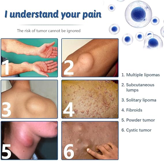 Advanced Lipoma Removal Cream